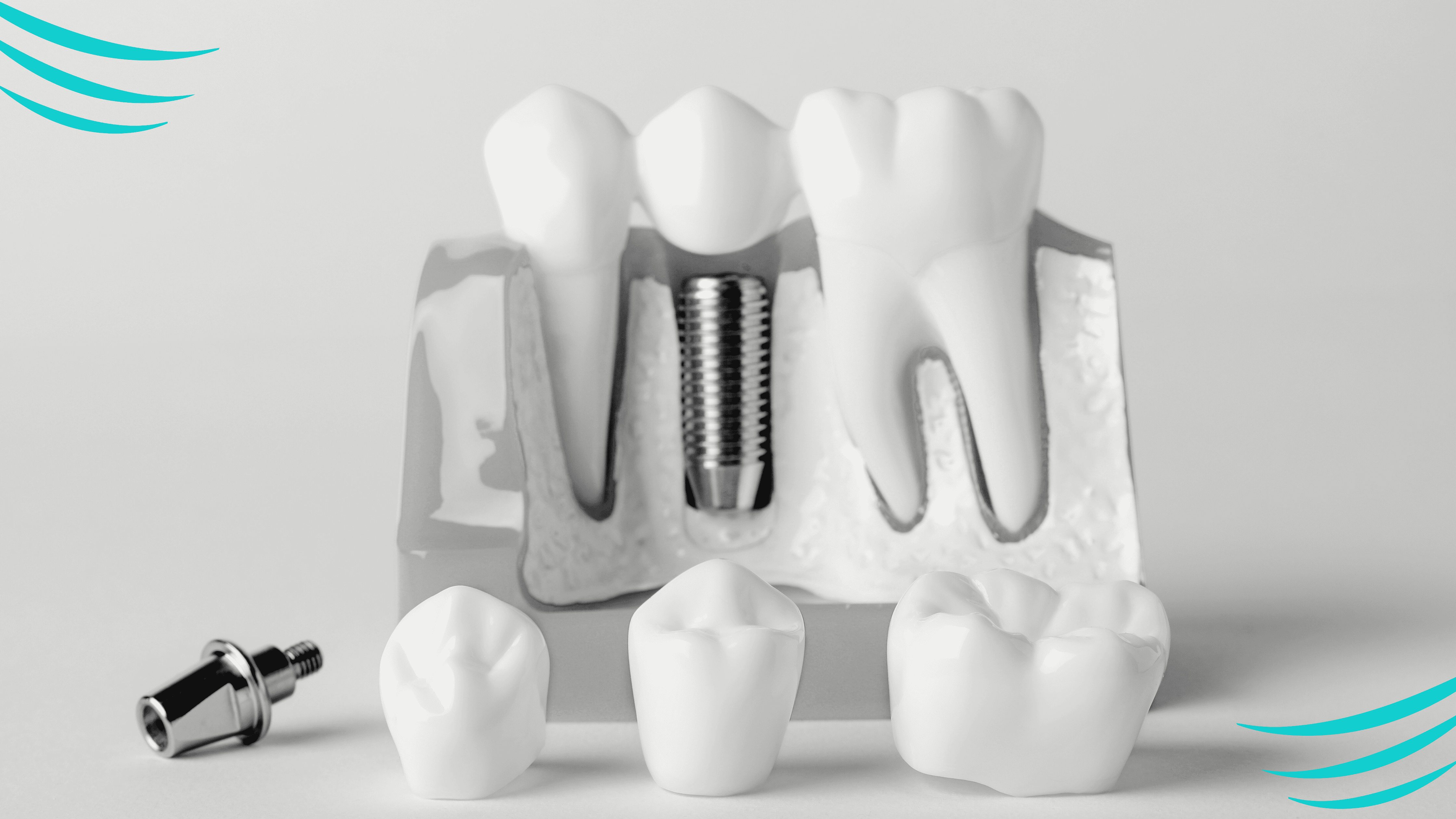 coroane dentare banner