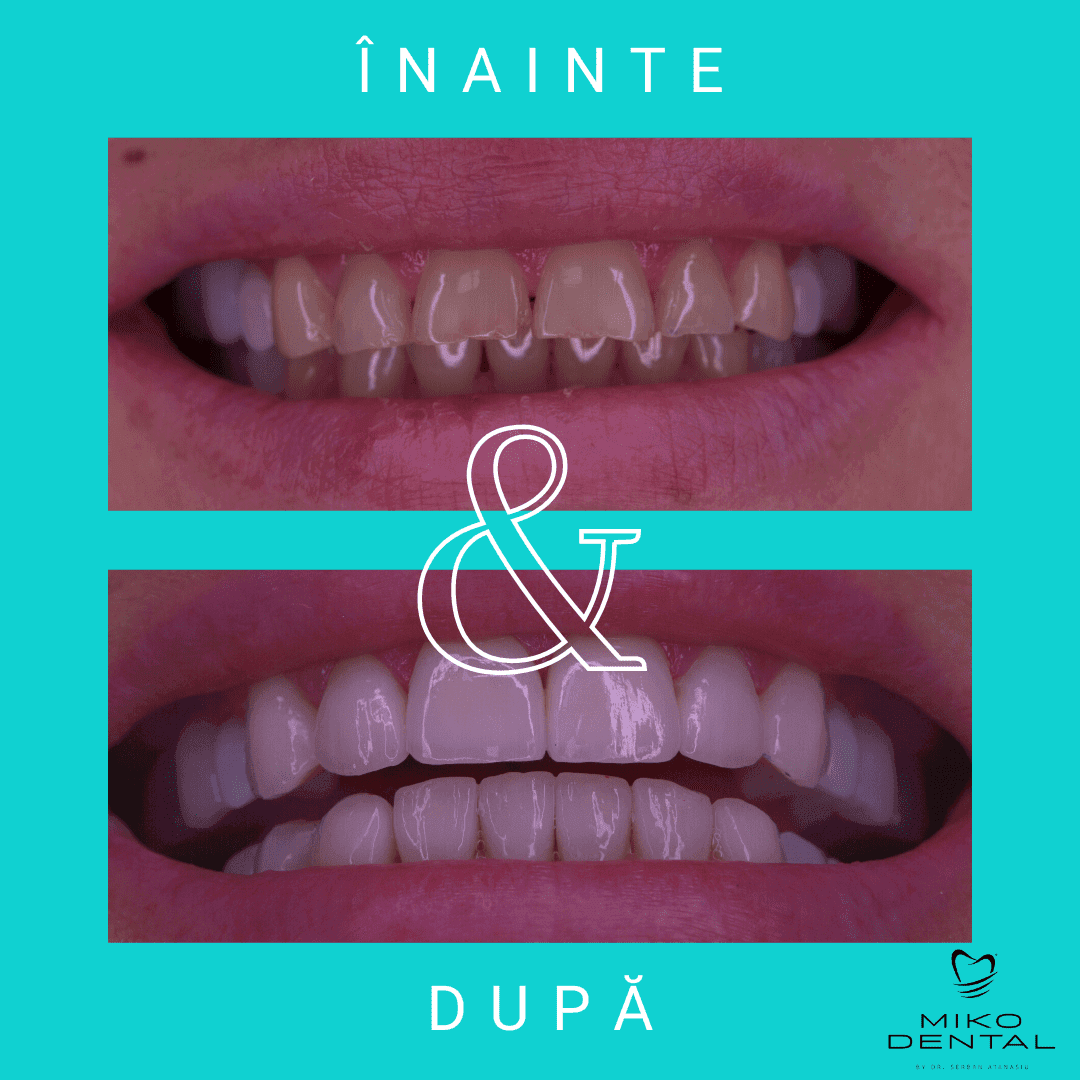 estetica-dentara-Caz 1