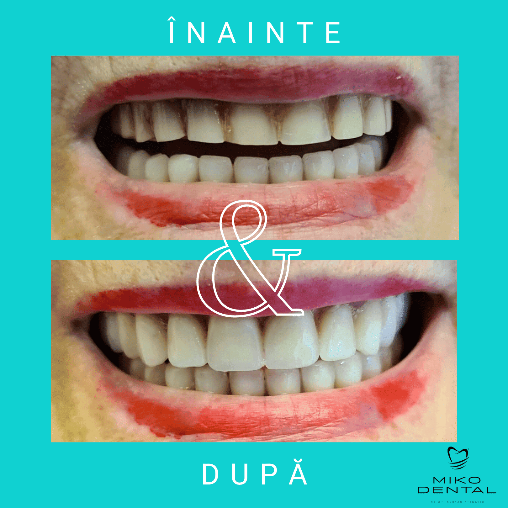 estetica-dentara-Caz 10