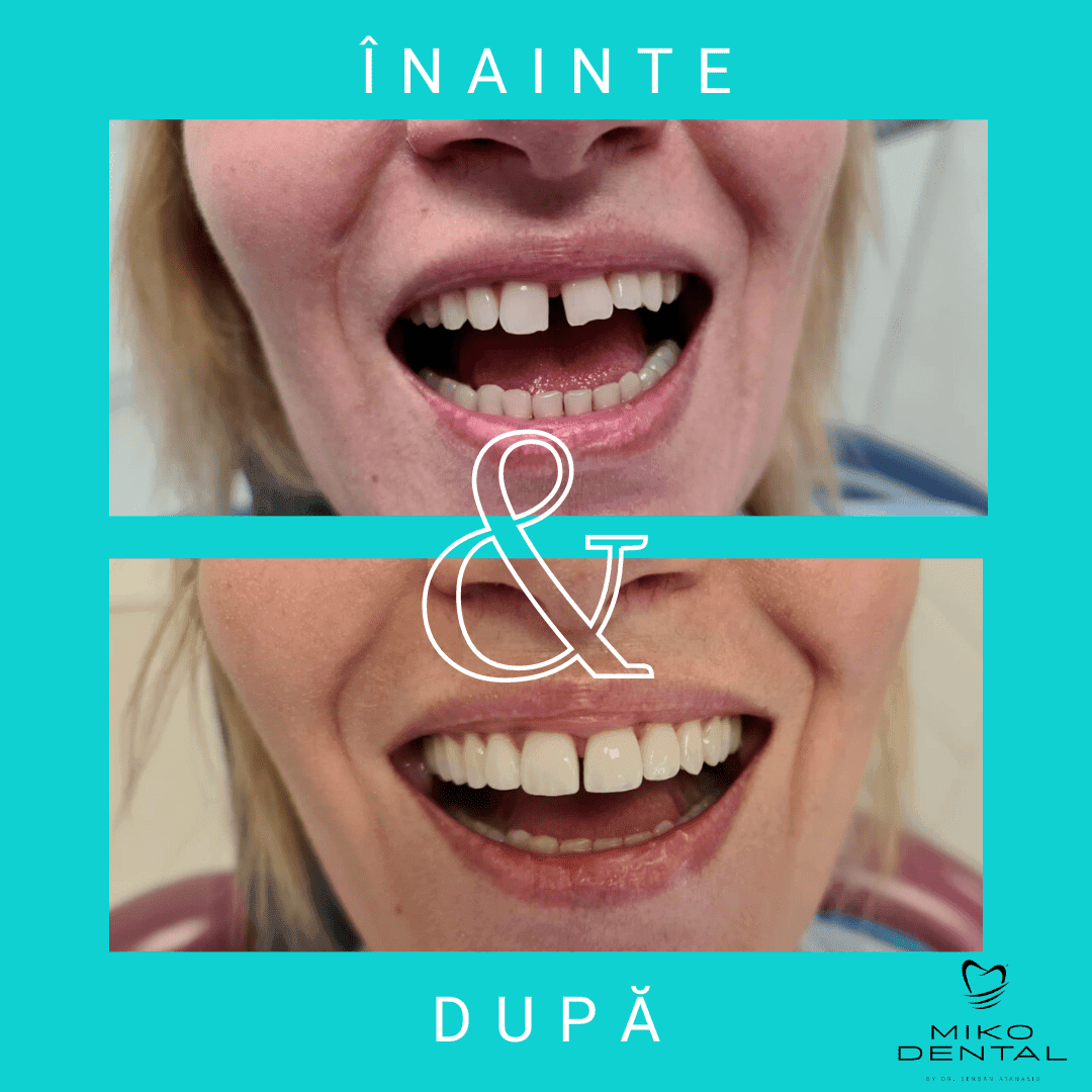 estetica-dentara-Caz 11.1