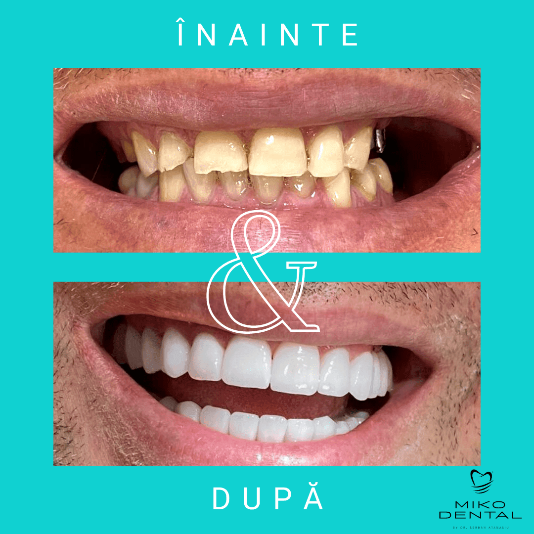 estetica-dentara-Caz 3
