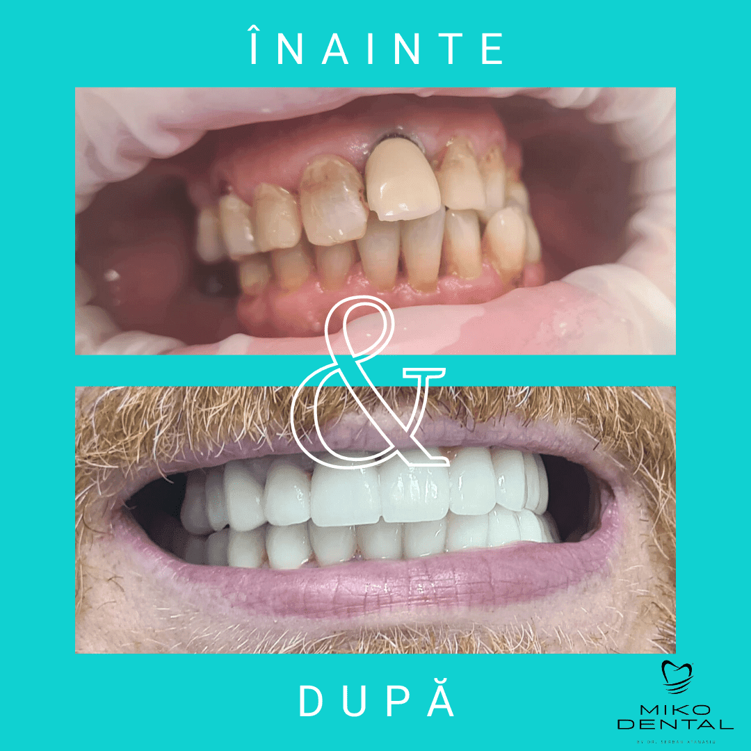 estetica-dentara-Caz 4