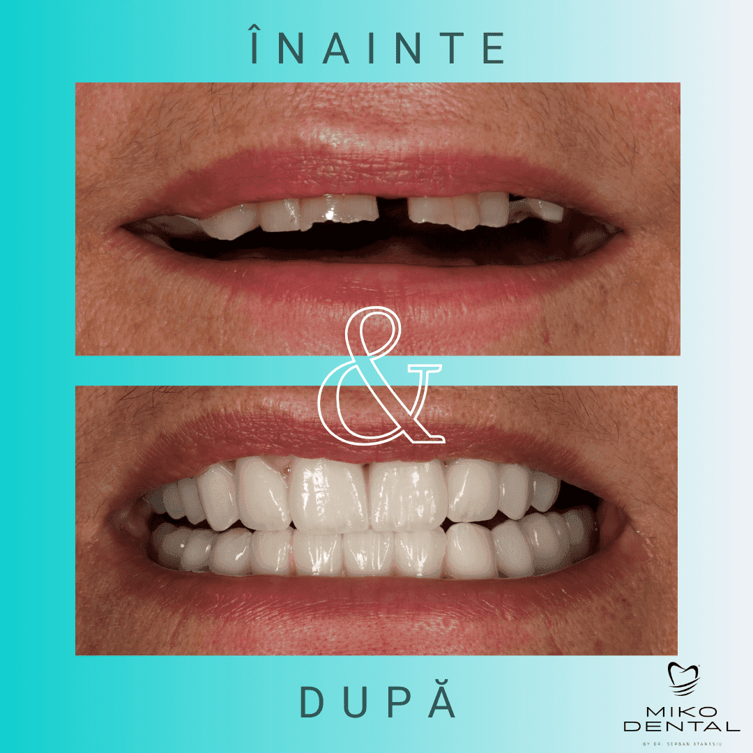 estetica-dentara-Caz 41