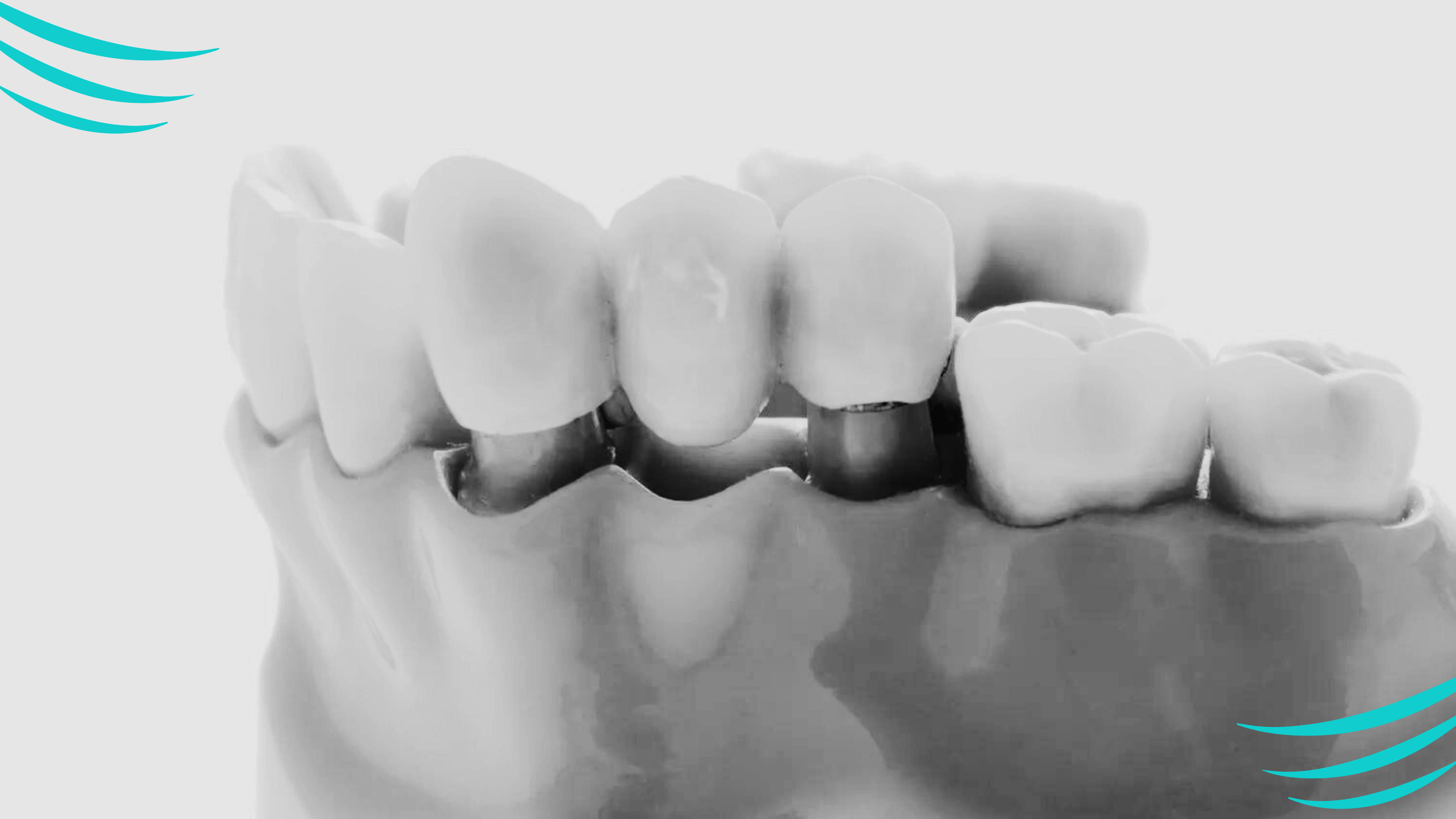 puntea dentara banner