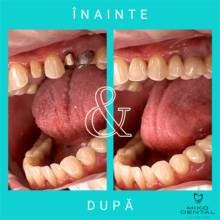 IMPLANTURI DENTARE_Caz 2