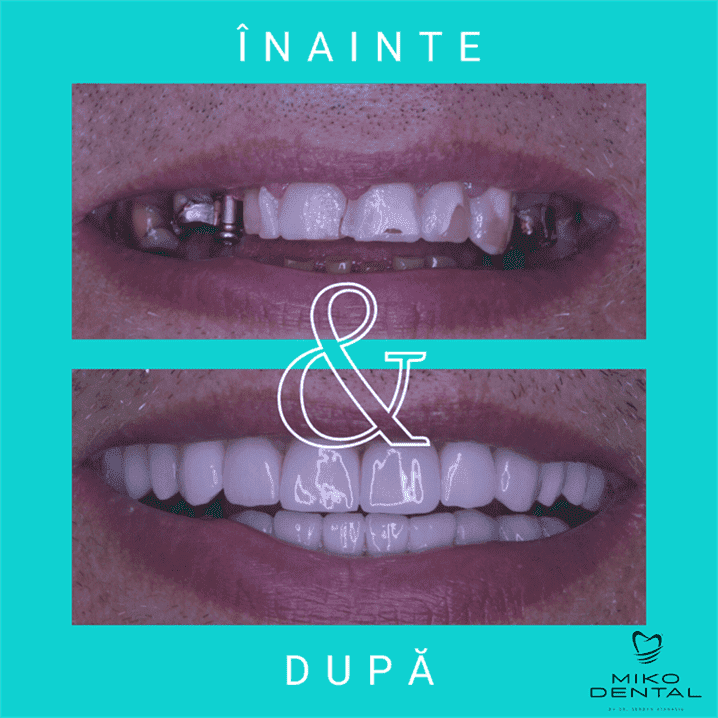 IMPLANTURI DENTARE_Caz 21