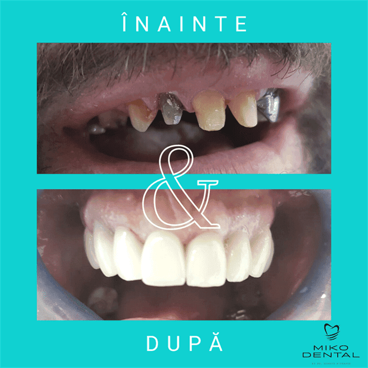 IMPLANTURI DENTARE_Caz 27