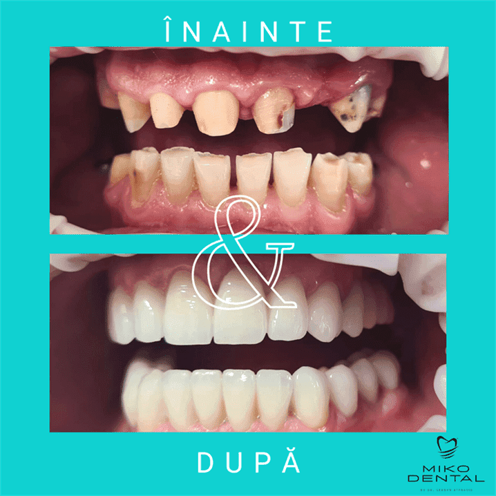 IMPLANTURI DENTARE_Caz 33