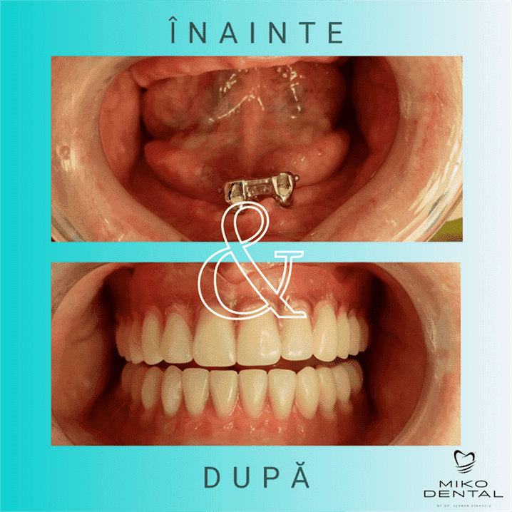IMPLANTURI DENTARE_Caz 36