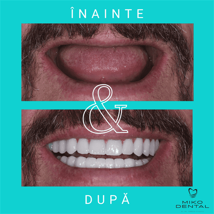 IMPLANTURI DENTARE_Caz 37