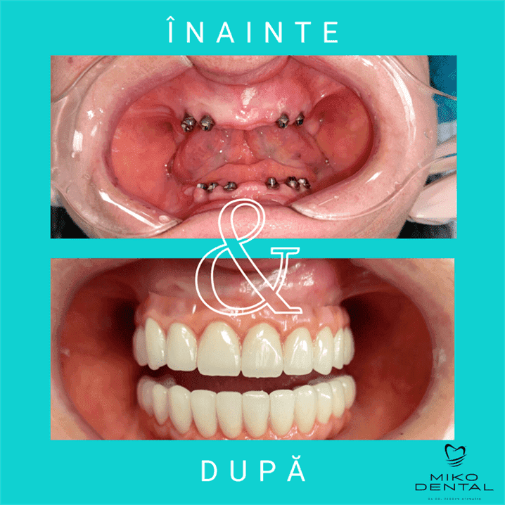 IMPLANTURI DENTARE_Caz 39