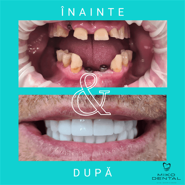 IMPLANTURI DENTARE_Caz 8