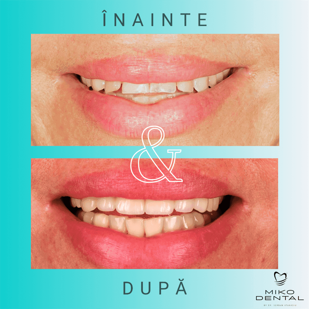 PROTETICĂ – COROANE ȘI FAȚETE DENTARE_Before after Dr Mihai Dorobantu