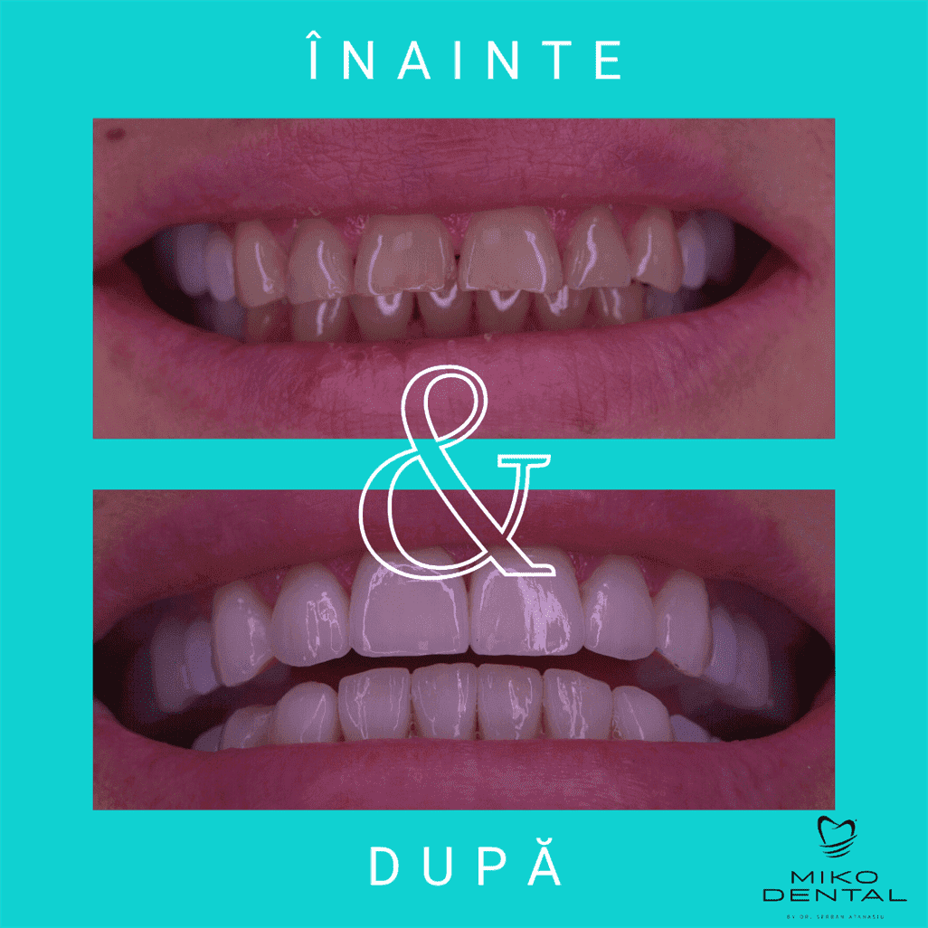 PROTETICĂ – COROANE ȘI FAȚETE DENTARE_Caz 1