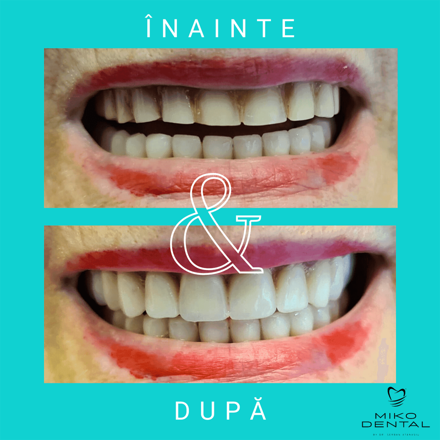 PROTETICĂ – COROANE ȘI FAȚETE DENTARE_Caz 10