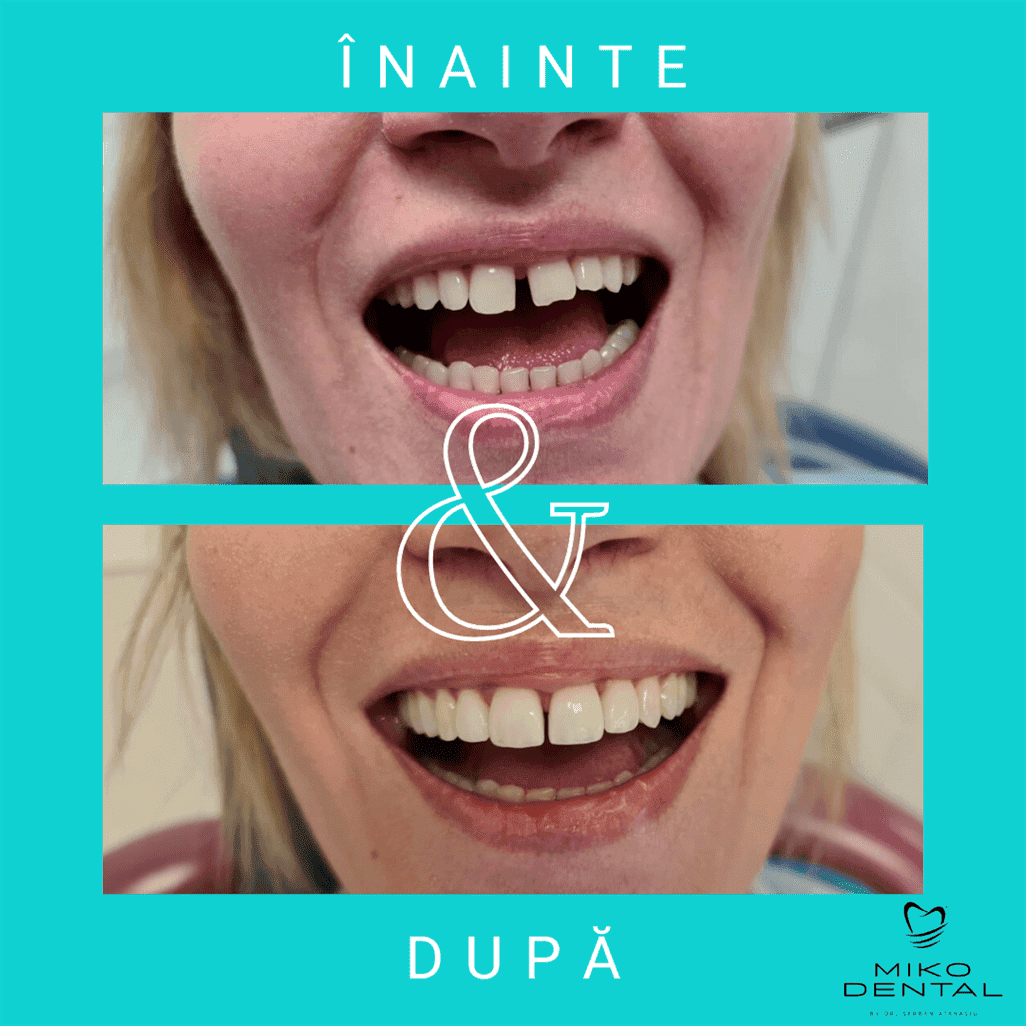 PROTETICĂ – COROANE ȘI FAȚETE DENTARE_Caz 11