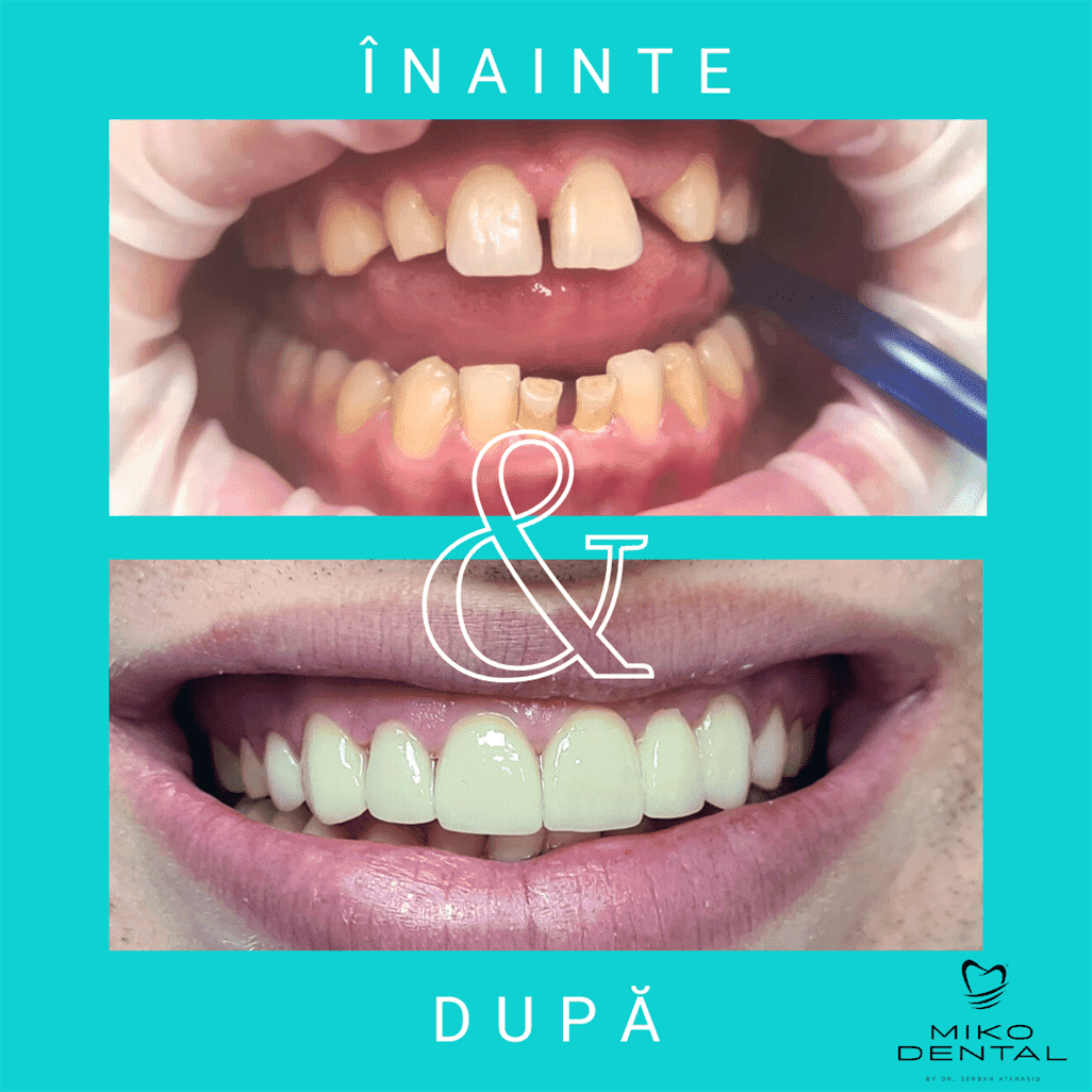 PROTETICĂ – COROANE ȘI FAȚETE DENTARE_Caz 13