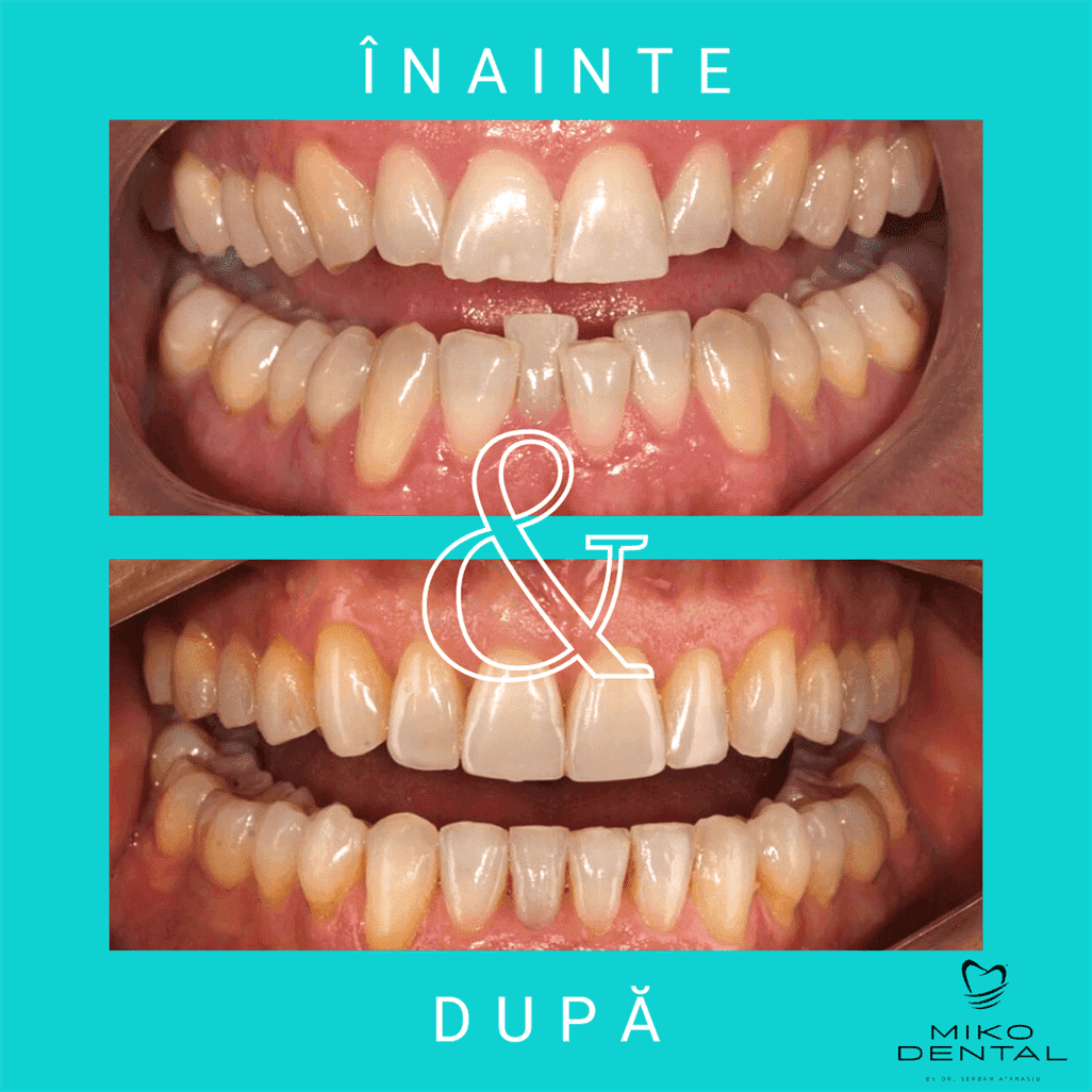 PROTETICĂ – COROANE ȘI FAȚETE DENTARE_Caz 14