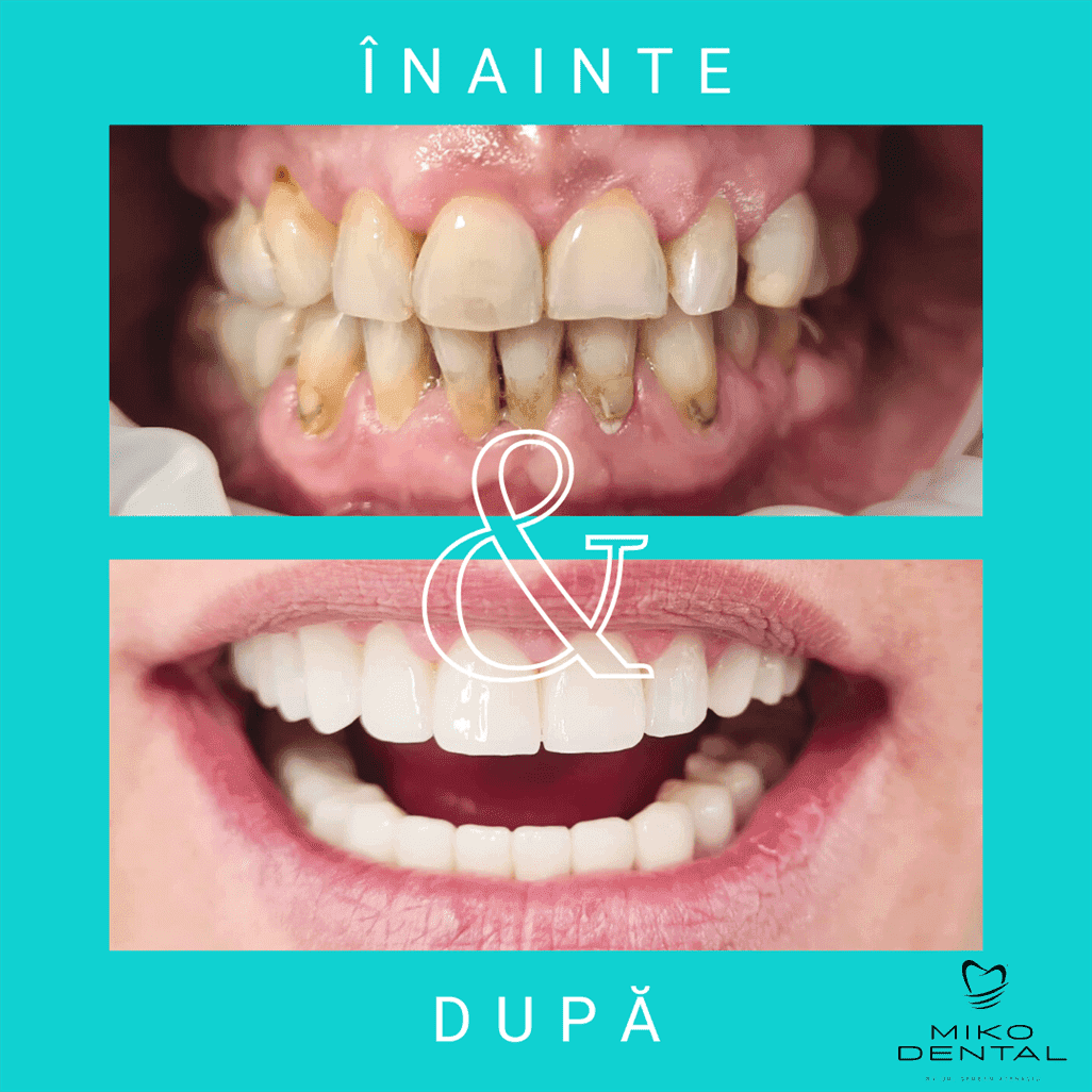 PROTETICĂ – COROANE ȘI FAȚETE DENTARE_Caz 15