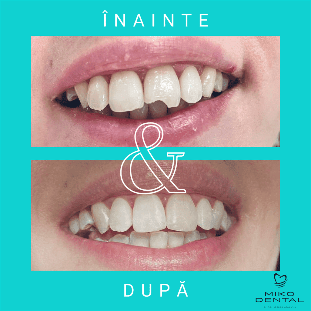 PROTETICĂ – COROANE ȘI FAȚETE DENTARE_Caz 24