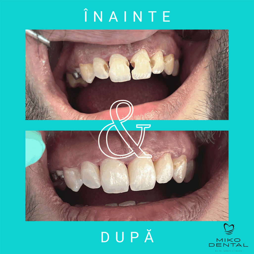 PROTETICĂ – COROANE ȘI FAȚETE DENTARE_Caz 28