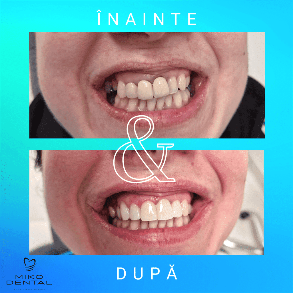 PROTETICĂ – COROANE ȘI FAȚETE DENTARE_Caz 29