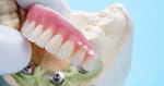 Protetica fixă – preturi - Miko Dental