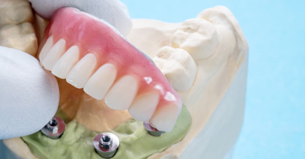 Protetica fixă – preturi - Miko Dental