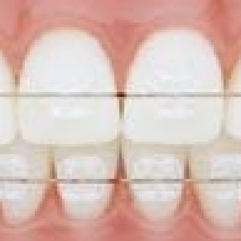 Aparat dentar safir invizibil