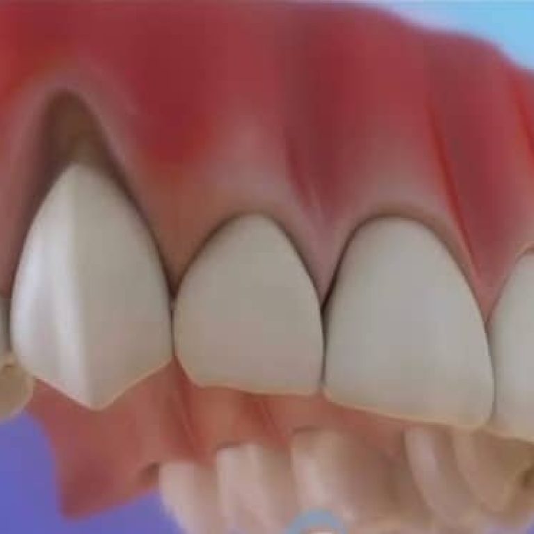 Grefa gingivala